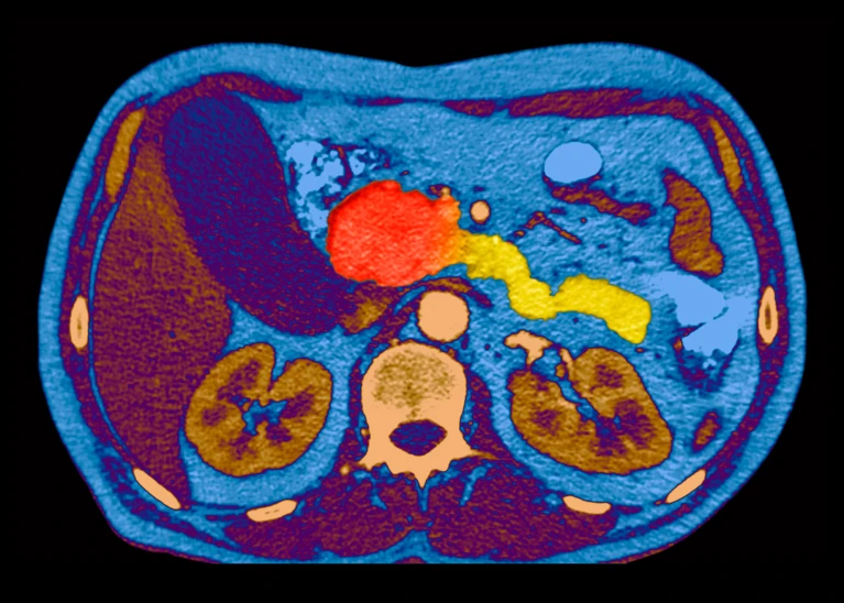 Pancreatic-head tumours (red, artificially coloured) have proved highly resistant to treatment, but a new drug nearly doubles the lifespan of people with this type of cancer. Nguồn: PNMB/Science Photo Library